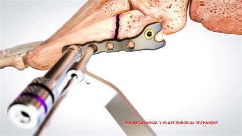 Bone Plating .